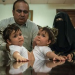 世界各地連體嬰都有機會在這裏接受手術—沙特政府推動慈善項目造福貧窮家庭